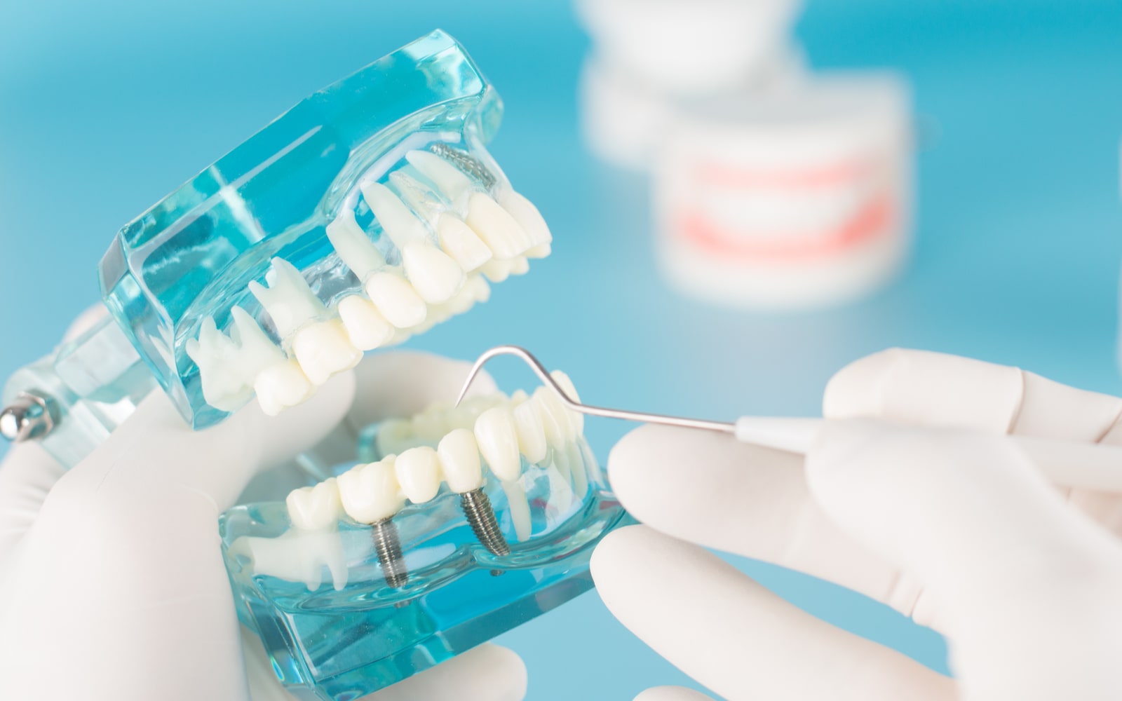 How Endodontic Implants Took Restoration Dentistry by Storm
