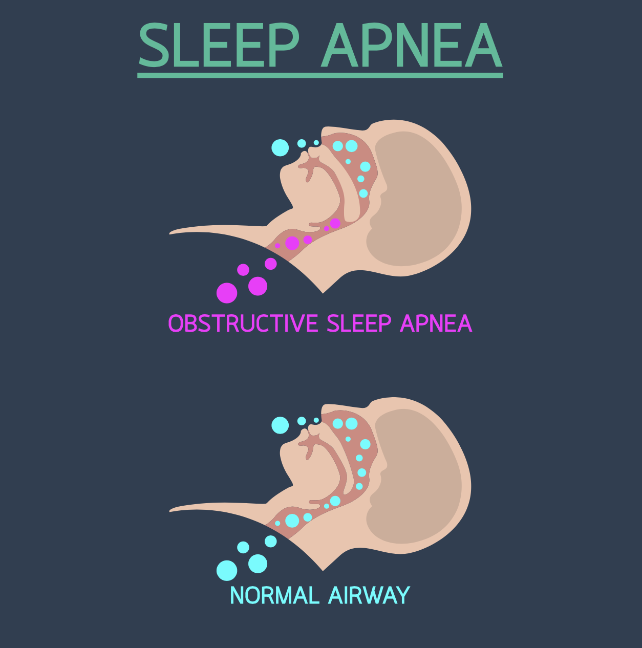 illustration showing the difference between the normal airway and one caused by obstructive sleep apnea and health