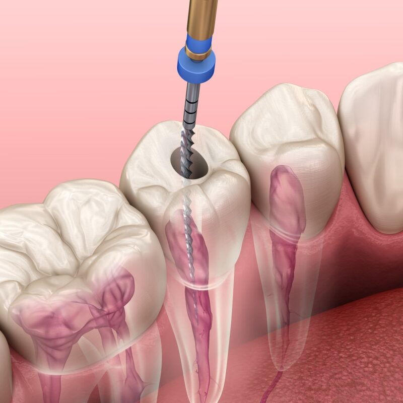 Root Canal Treatment Vector