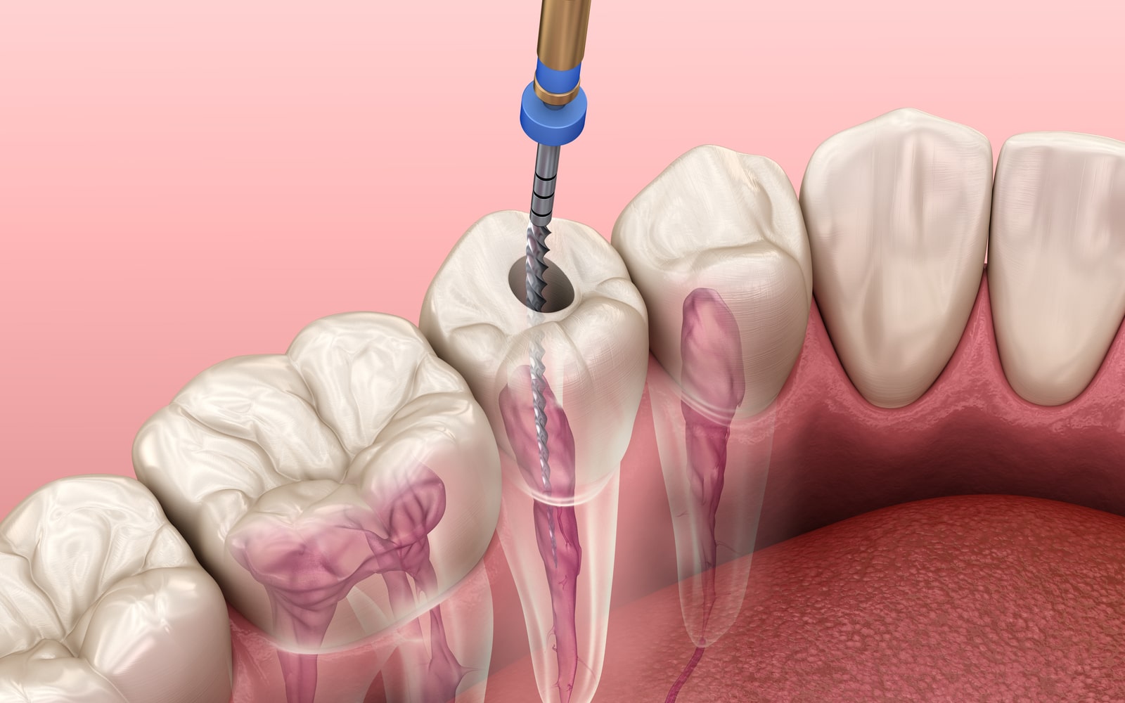 Root Canal Treatment Vector