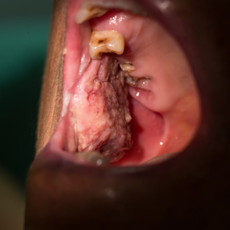 Oral Cancer Patient
