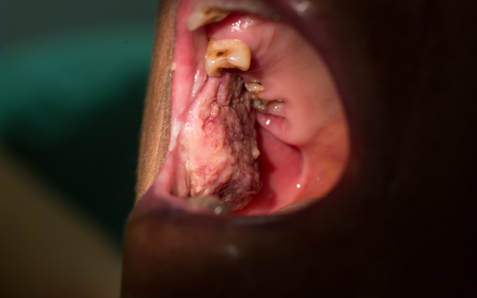 Oral Cancer Patient