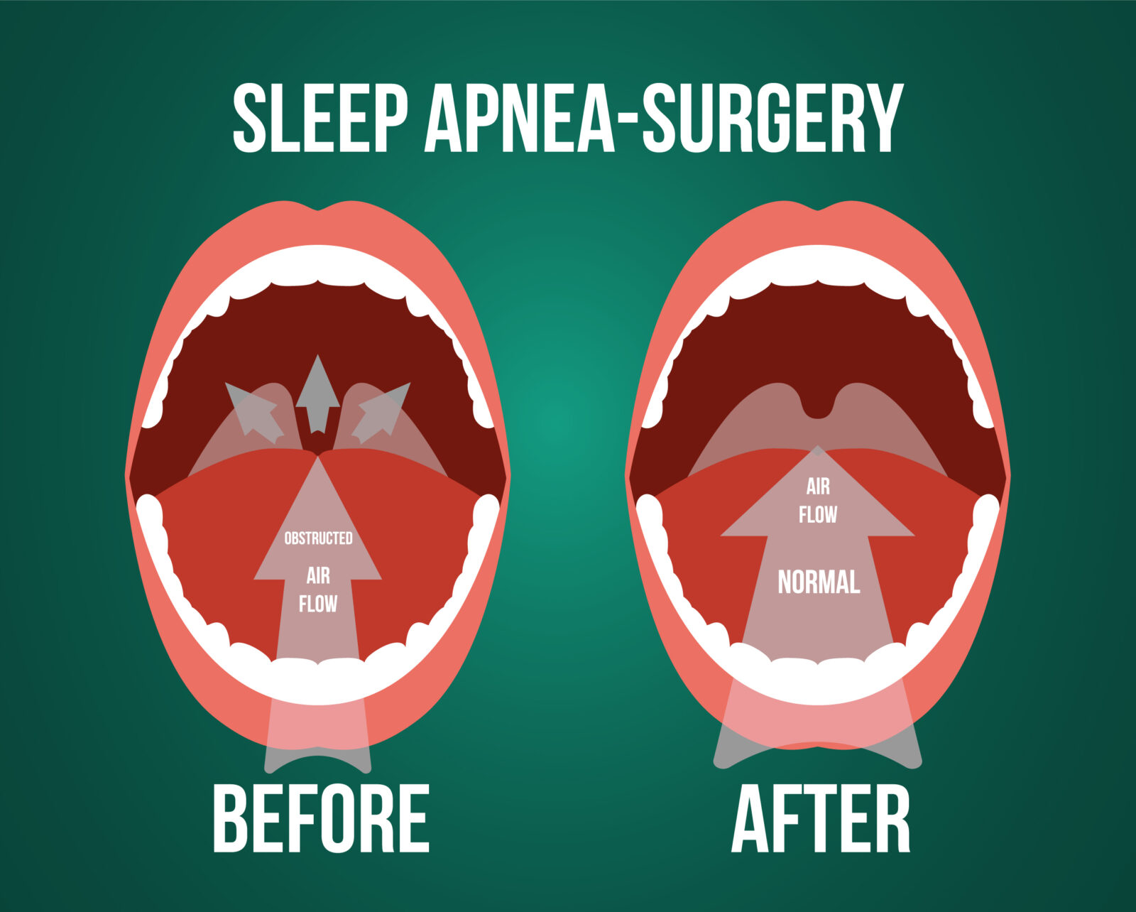 What is Somnoplasty for snoring? 1