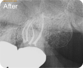 Dental X-ray after root canal treatment.