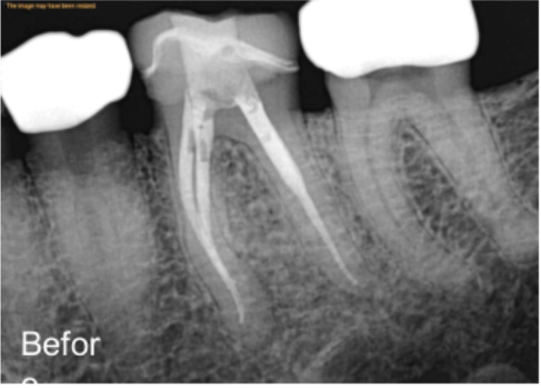 Dental X-ray before GentleWave treatment.