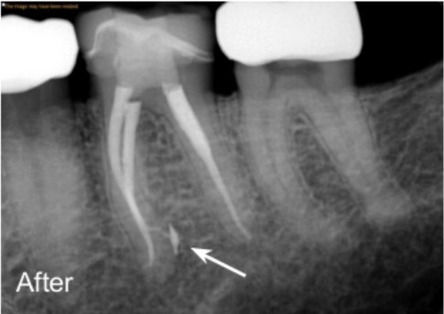 Dental X-ray after GentleWave treatment.