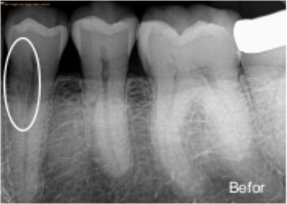 Pre-operative radiograph showing cervical resorption.