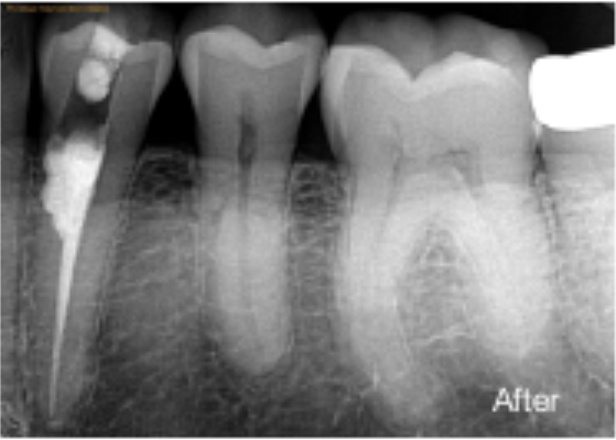 Post-operative radiograph showing sealed canal system and repaired defect.